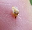 abeille (Apis mellifica) , aiguillon dans mon doigt, photo 3.
